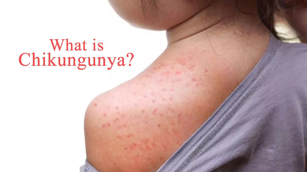 Combating the Virus Chikungunya - Strategic Measures and International Lessons for Vietnam’s Preparedness